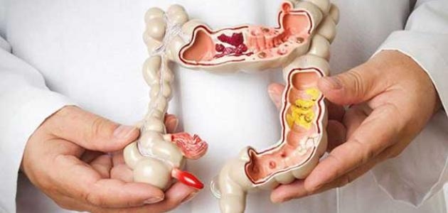 علاج طبيعي واعد للالتهابات المعوية