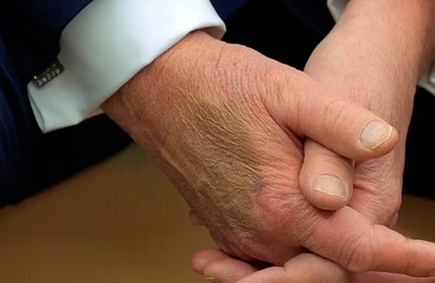 كدمة غامضة على يد ترامب اليمنى تعود للظهور وتثير التساؤلات مجددا