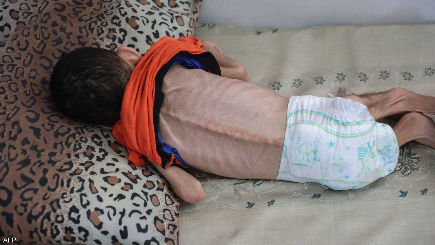 غزة بلا طعام أو مكملات غذائية…والمجاعة تفتك بالأطفال