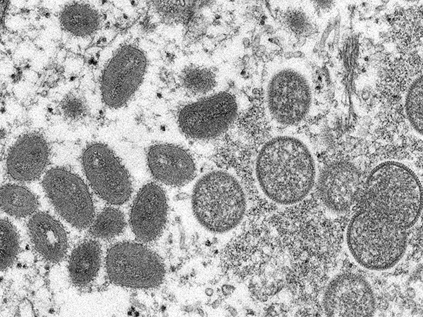 Pakistan confirms 2nd mpox case in 2025