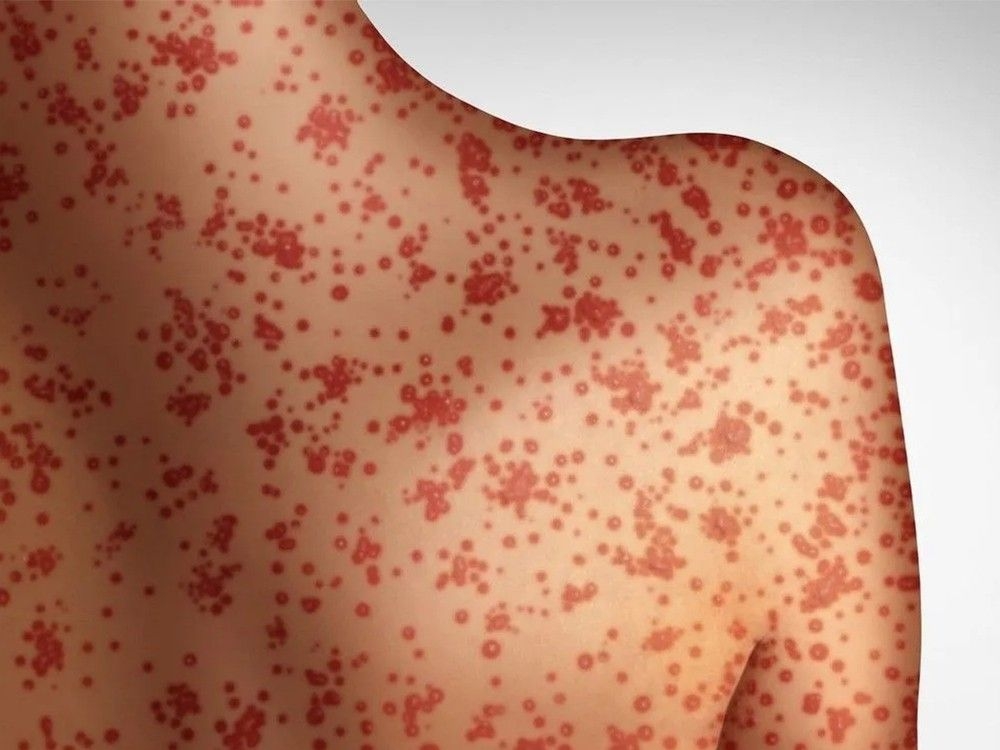Measles cases in Alberta rise to 210, with majority reported in kids and teenagers