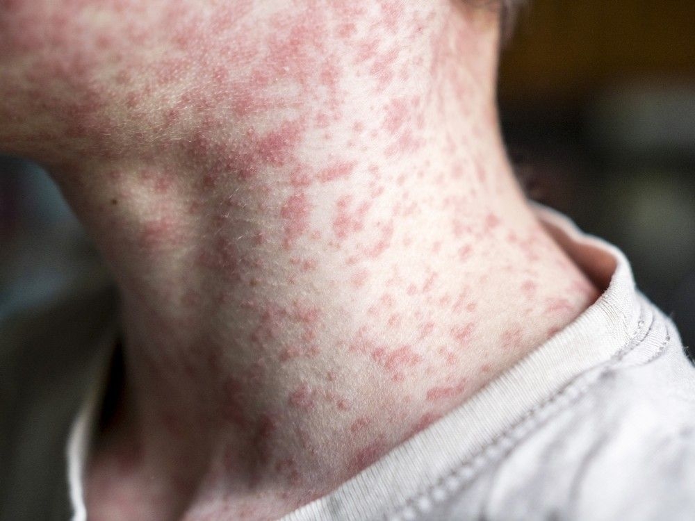 Alberta's measles count now over 500 cases in the province