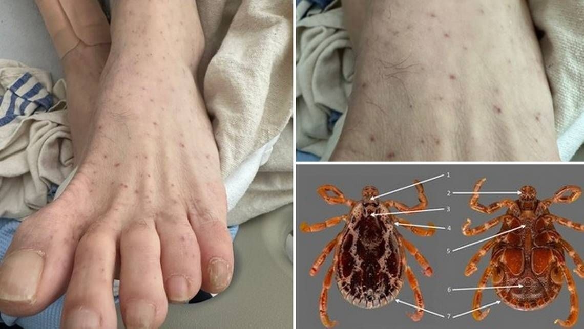 First case of Rocky Mountain spotted fever discovered in Quebec