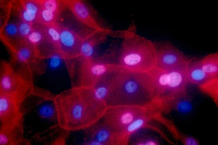 Chemotherapy can speed up cancer spread: study