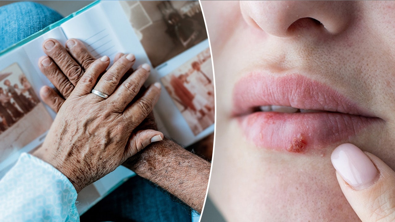 Cold sores may play role in Alzheimer's development, new research reveals