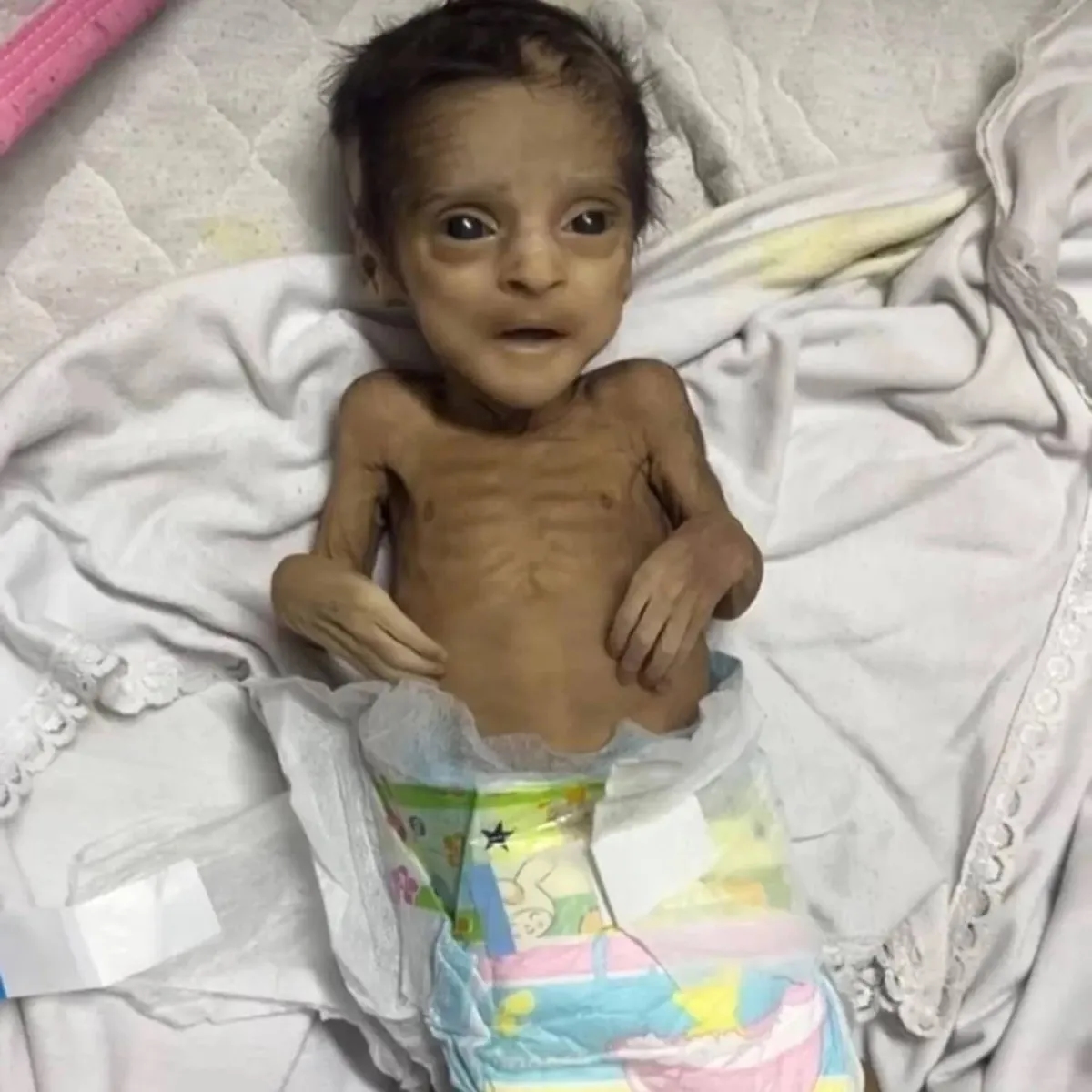 غزة: 67 طفلاً تُوفوا بسبب سوء التغذية وأكثر من 650 آخر في خطر حقيقي