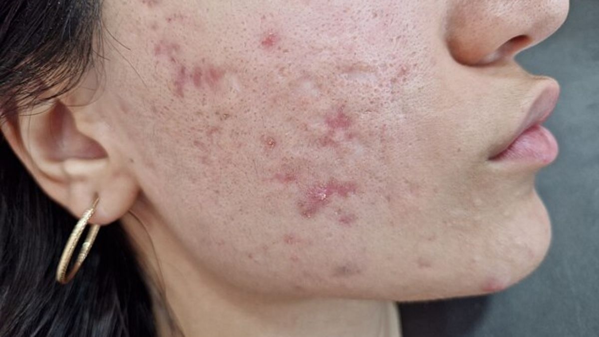 How PCOS wrecks your skin & hair—and what you can do about it