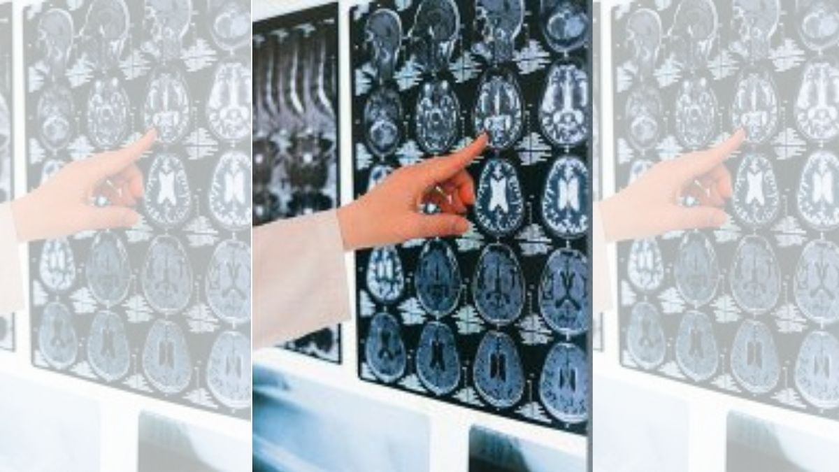 Harvard researchers may have found key piece to Alzheimer's puzzle. It was in the human brain all along