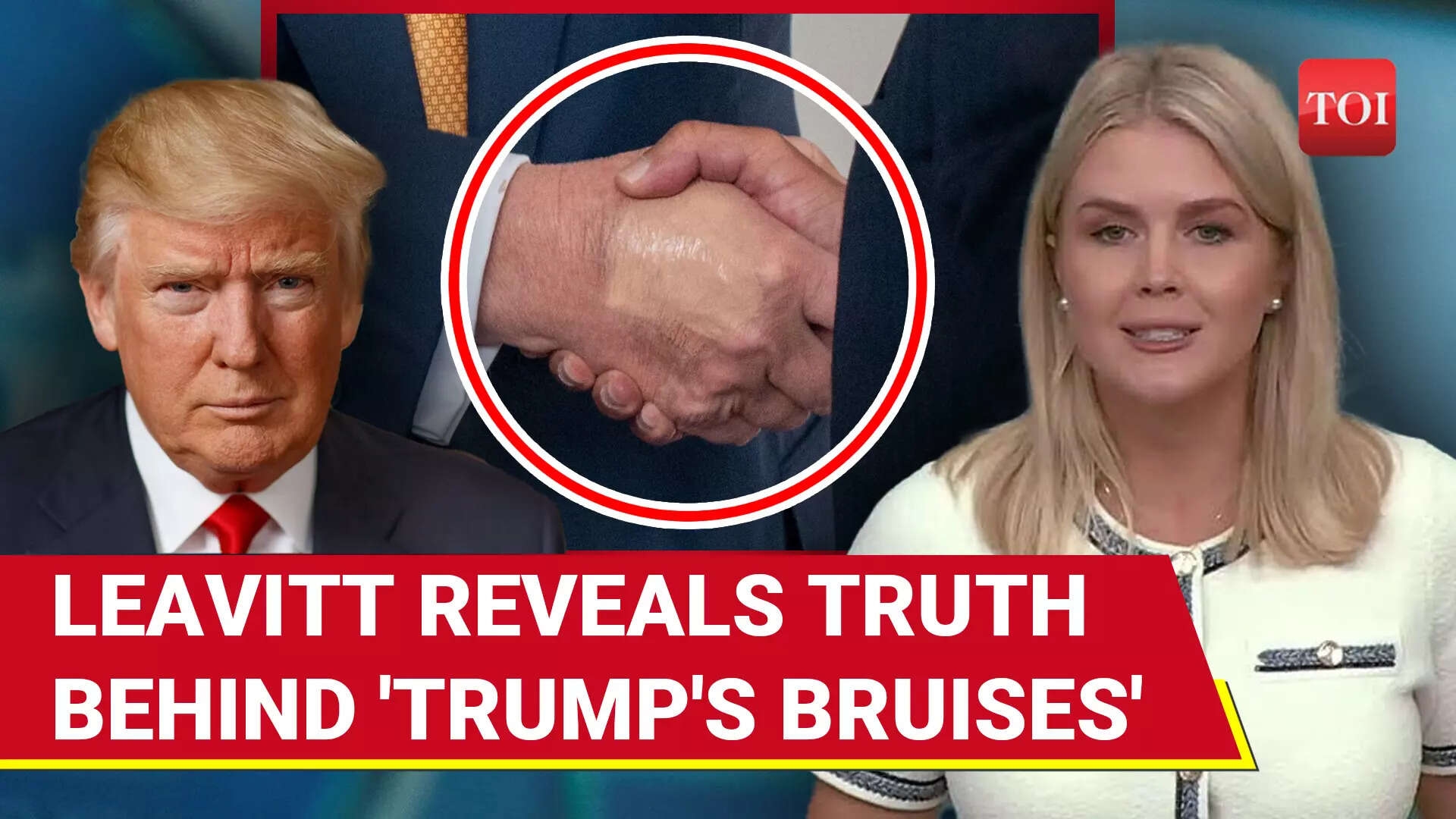 Trump Leg Swelling: Leavitt Scrambles To Explain 'Chronic Venous Insufficiency' After Media Buzz