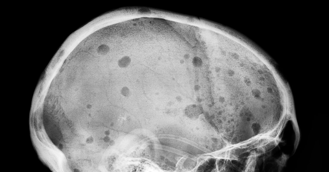 From No Hope to a Potential Cure for a Deadly Blood Cancer