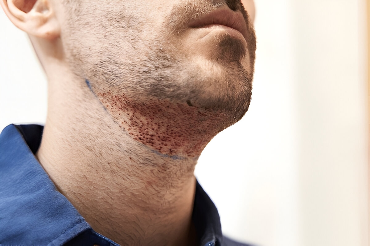 Real UK Hair Transplant Results You'll Want to See
