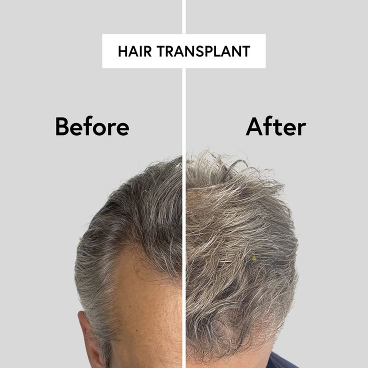 Is It Safe to Combine the Procedure with Other Hair Loss Treatments