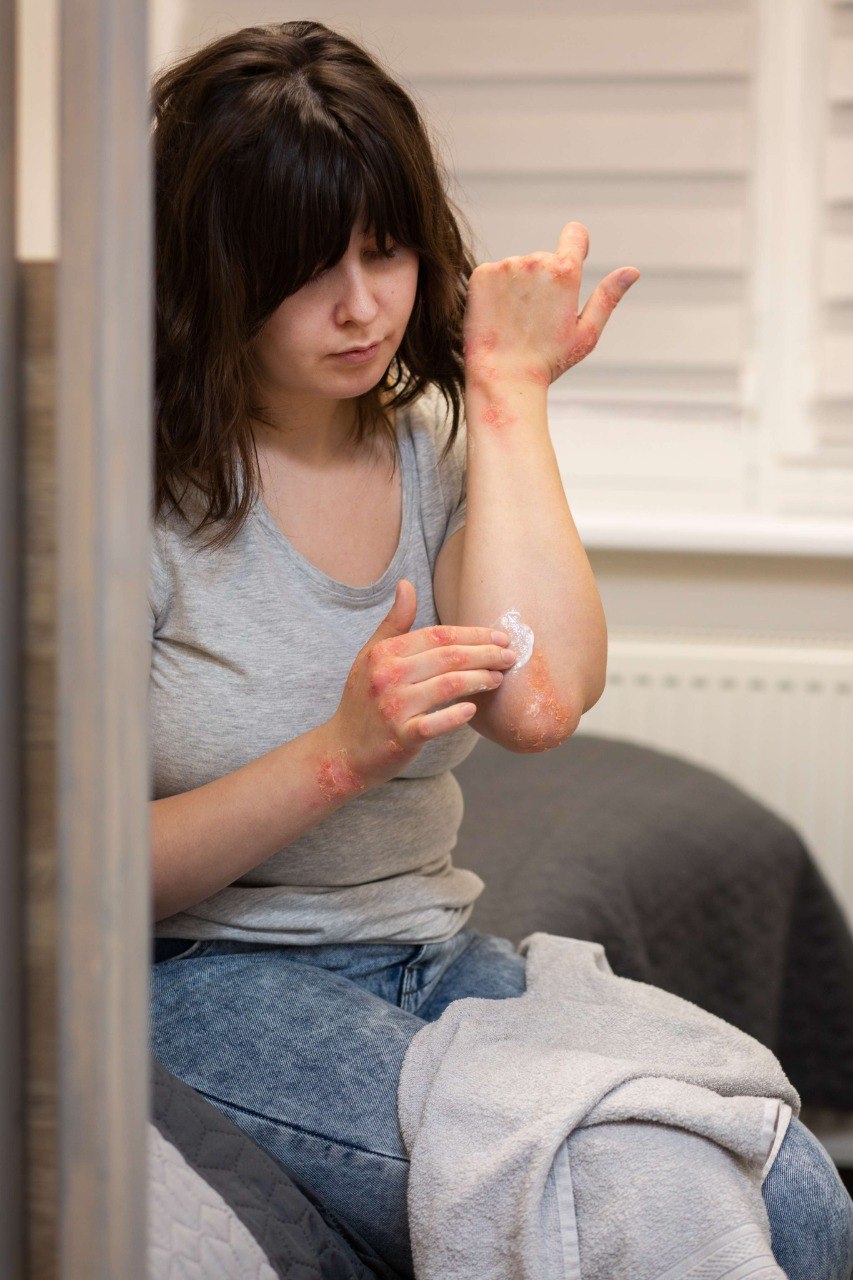 Scabies vs Filariasis: What's the Difference?