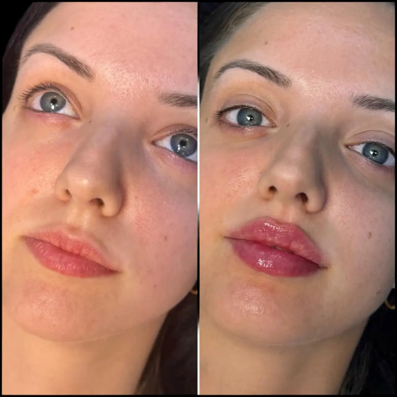 First-Time Fillers? Advice from Best Doctors in Dubai