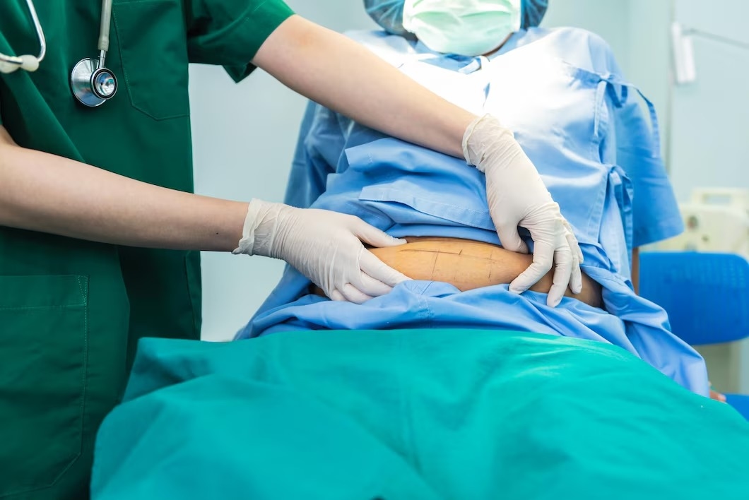 What to Expect After Gastric Sleeve Surgery?