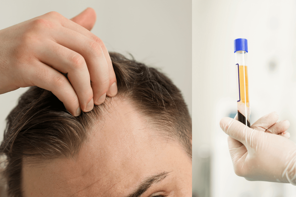 Can PRP Help with Receding Hairlines? Expert Insights