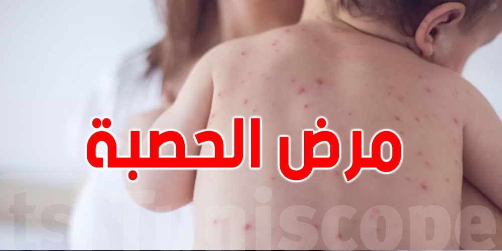 عاجل : دولة عربية تعلن تحوّل الحصبة إلى وباء