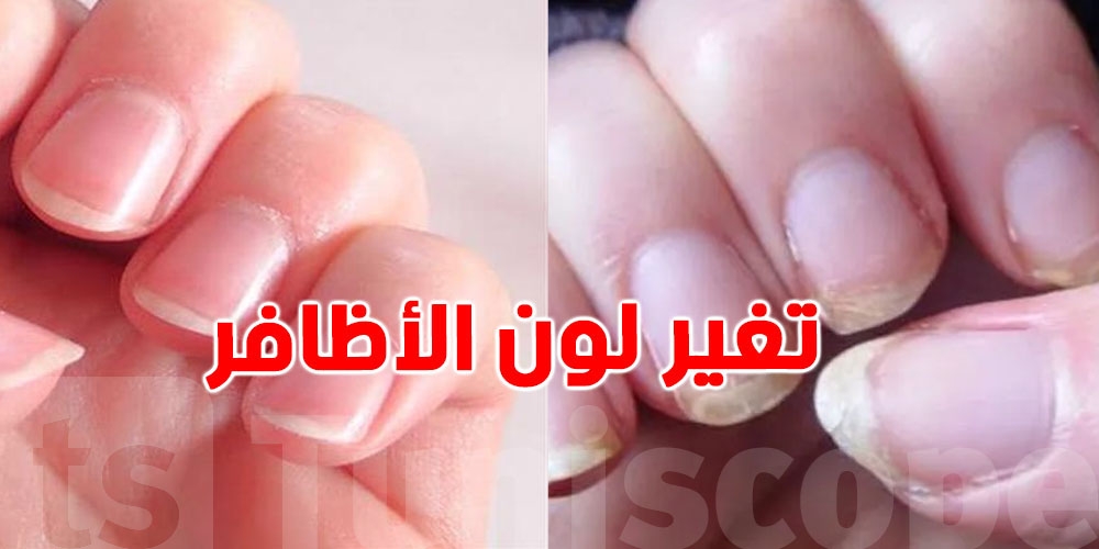 ألوان الأظافر قد تكشف عن حالتك الصحية