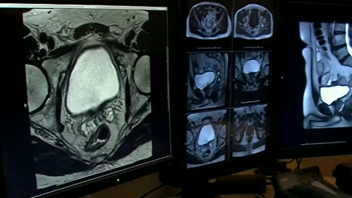 More Aussies to be tested for prostate cancer in world-first reforms