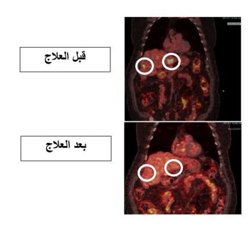إنجاز طبي جديد في مستشفى الملك المؤسس