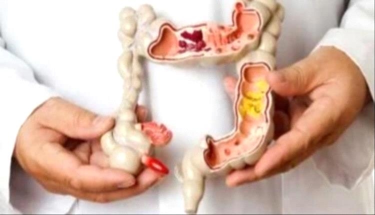 أطعمة ومشروبات تسبب متاعب القولون.. تجنبها فى رمضان