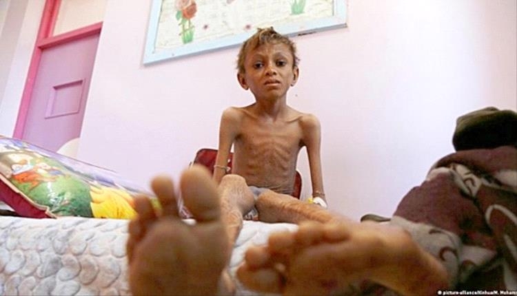 اليونيسيف: اليمن يواجه كارثة غذائية