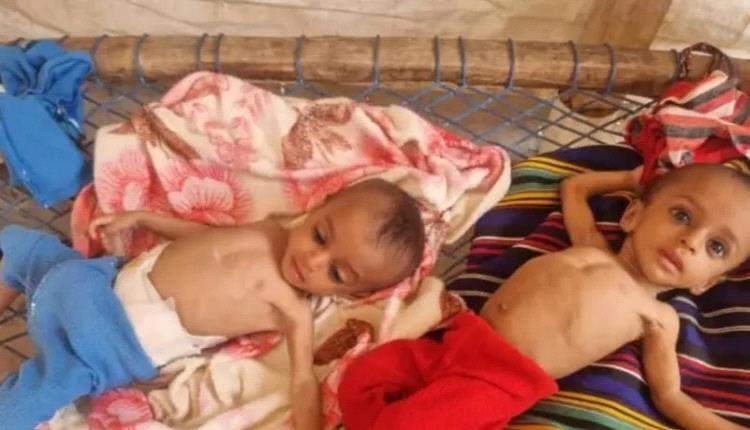 وفاة طفلة نازحة جراء سوء التغذية.. المجاعة تطرق أبواب اليمن