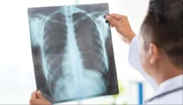 أسباب الالتهاب الرئوى الحاد.. اعرف علاماته المبكرة وعوامل الخطر