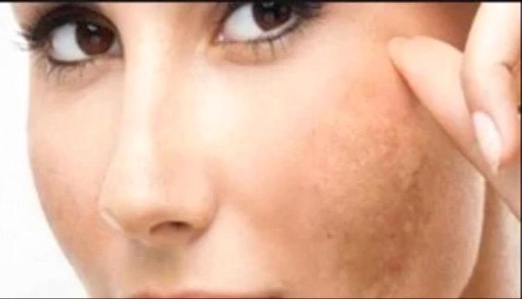 أسباب ظهور البقع الخشنة الجافة على الوجه وطرق العلاج