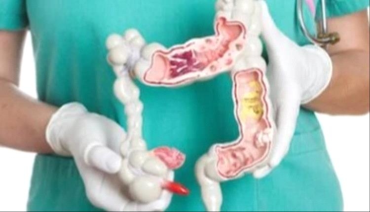 علماء يكشفون عن وجبة خفيفة قد تقلل من خطر الإصابة بسرطان القولون