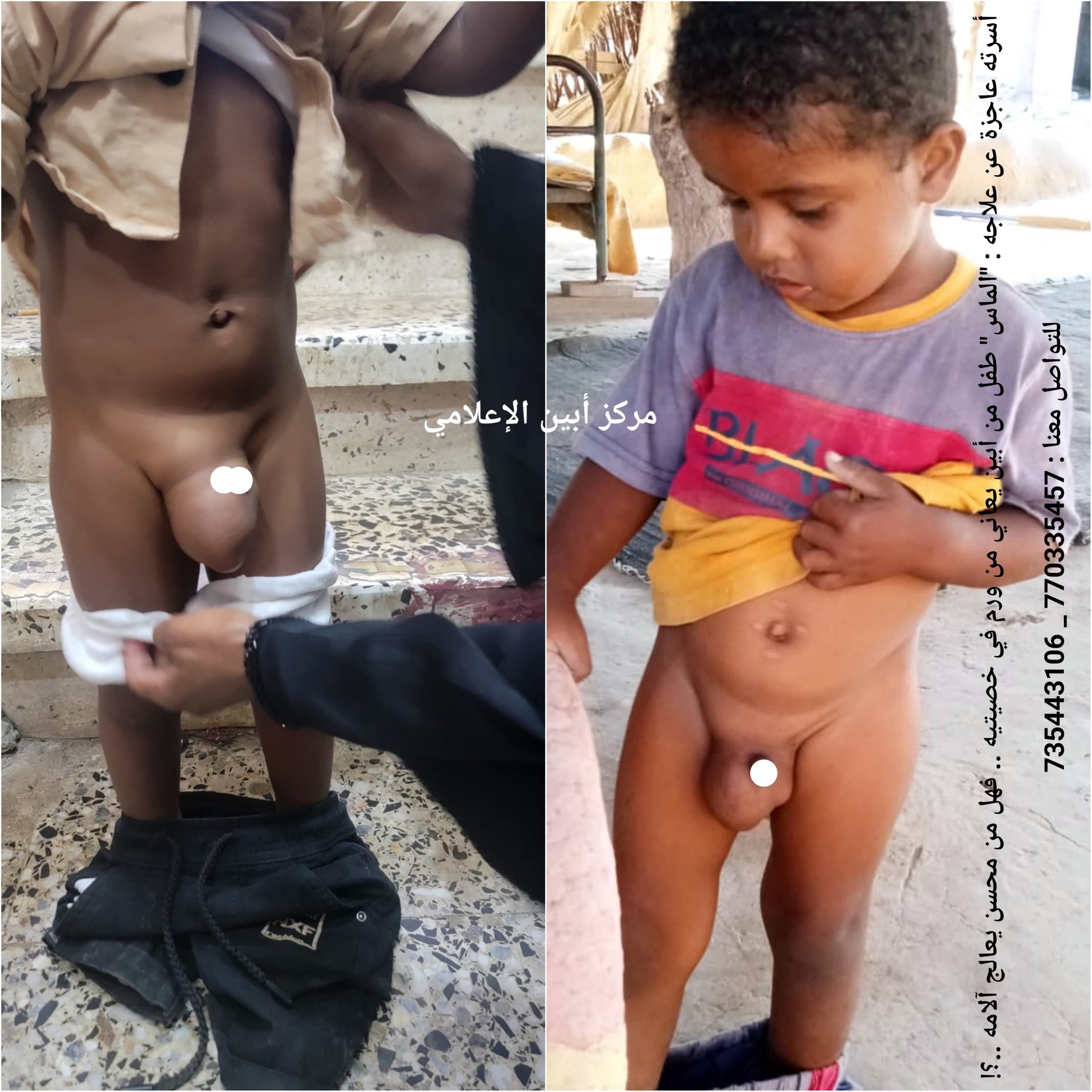 الماس' طفل من أبين يعاني من ورم في خصيتيه .. فهل من محسن يعالج آلامه ..؟!