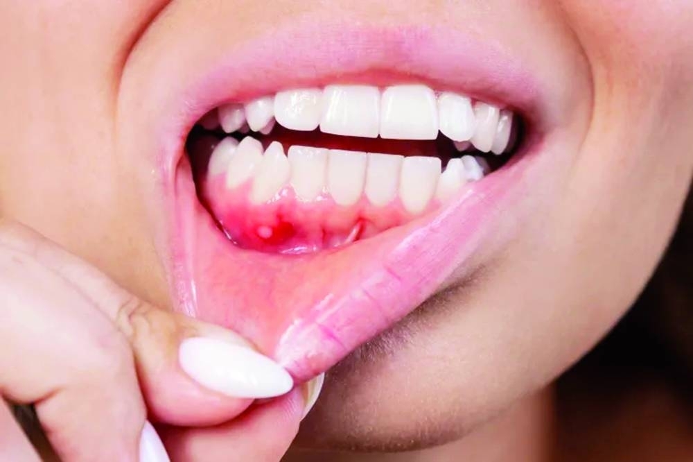 القرح الفموية المستمرة
