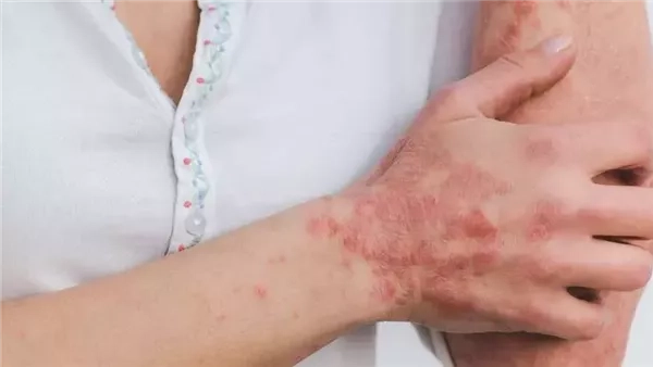 دراسة تكشف عن علاج واعد للصدفية بدون آثار جانبية
