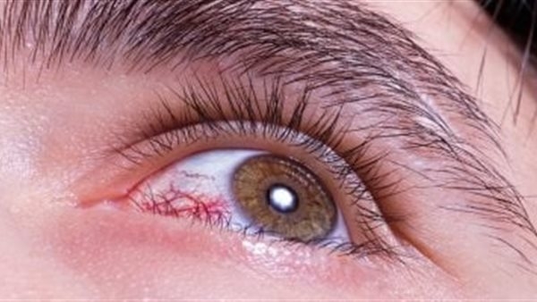 كيف تؤثر موجة الحر على صحة العين؟.. نصائح للوقاية