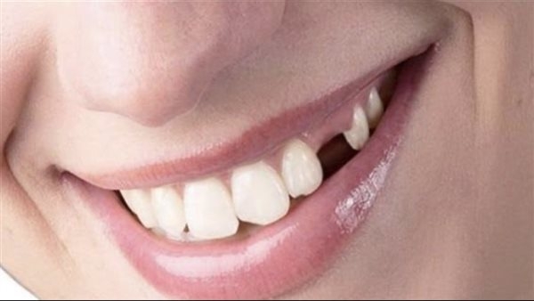 تفسير حلم تساقط الأسنان.. ماذا قال ابن سيرين؟