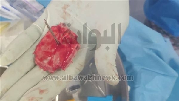 استخراج جسم معدني خطير من جمجمة طفل دون مضاعفات بمستشفى الفيوم الجامعي