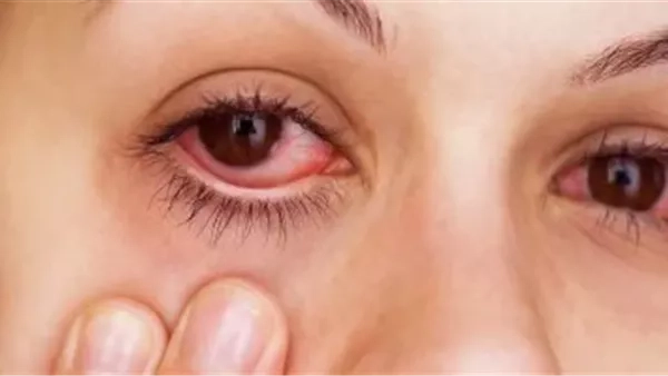قبل بدء فصل الصيف رسميًا.. احذر من أمراض قد تصيب العيون نتيجة ارتفاع درجات الحرارة.. فما هي هذه الأمراض؟ وطرق الوقاية منها