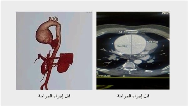 نجاح أول جراحة لاستبدال الشريان الأورطي بمستشفى المقطم للتأمين الصحي