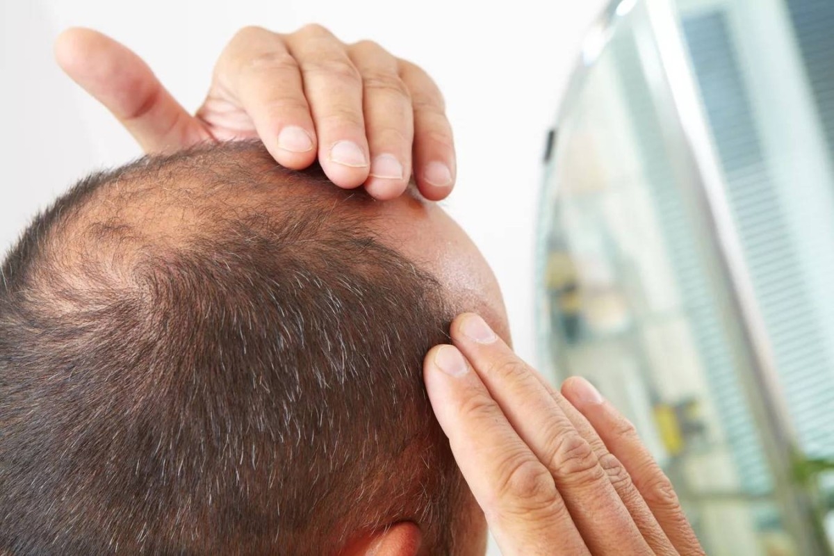بروتين يمكنه علاج تساقط الشعر