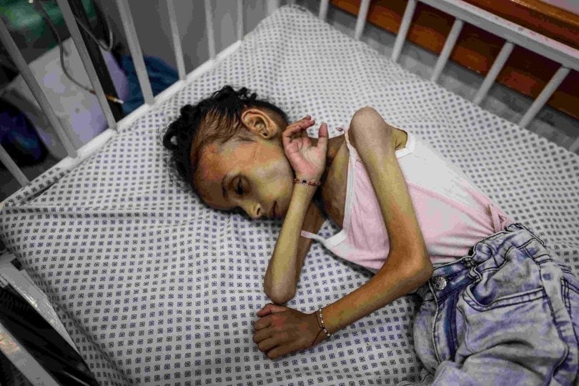 الطفلة مريم.. جسد نحيل أنهكه التجويع الإسرائيلي في غزة- (صور)