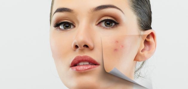 حب الشباب يزيد مخاطر التعرض للاضطرابات الغذائية
