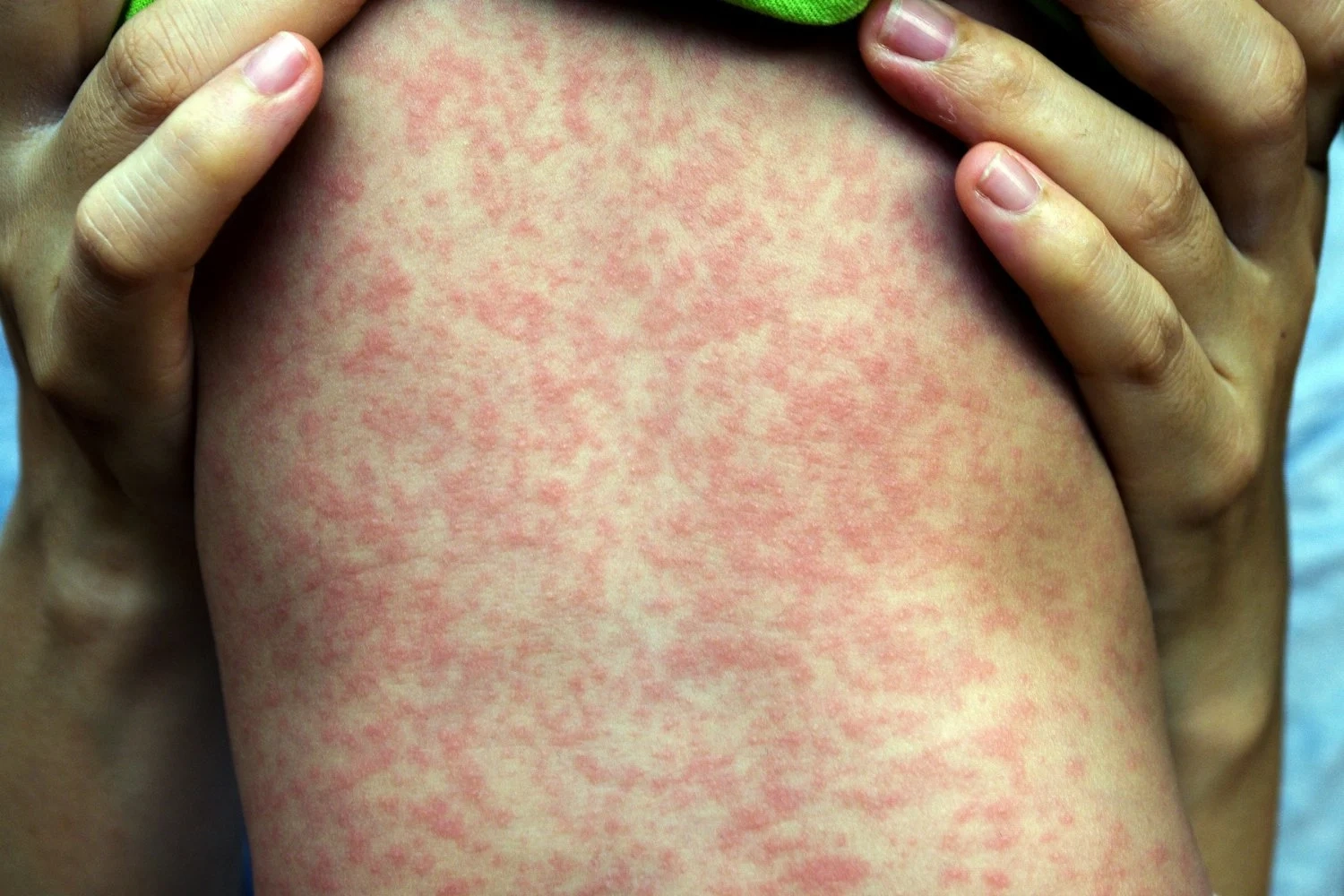 حصيلة إصابات الحصبة تتجاوز الألف حالة في أمريكا