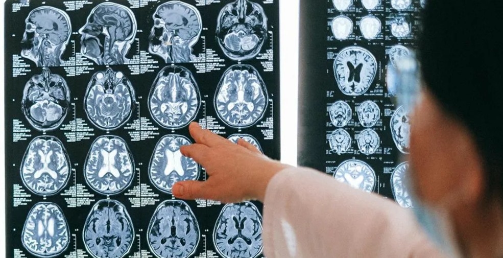دراسة تربط دواء شائع لآلام الظهر بزيادة خطر الخرف