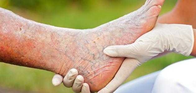 : تنبيه هام: فئات محددة أكثر عرضة للإصابة بدوالي القدمين