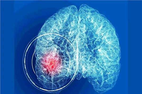 : 4 مشاهير يعانون من تمدد الأوعية الدموية في الدماغ