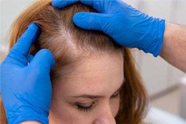 : أسباب وعلاج الصلع ومعلومات عن «مينوكسيديل»
