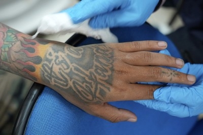 Muslims with tattoo regrets flock to a free removal service during Ramadan
