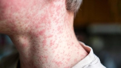 CDC warns of measles risk at airports and on flights, urges vaccination