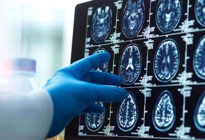 COVID-19 accelerated brain aging, regardless of infection: study