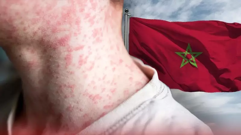 اخبار سارة للمغاربة بخصوص بوحمرون؟
